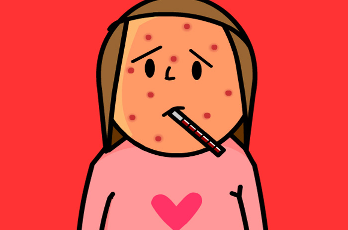 بیماری آبله مرغان (Chickenpox) بیماری آبله مرغان (Chickenpox)