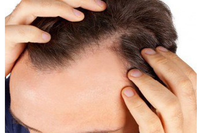 تغذیه و سلامت موی سر (بخش دوم)